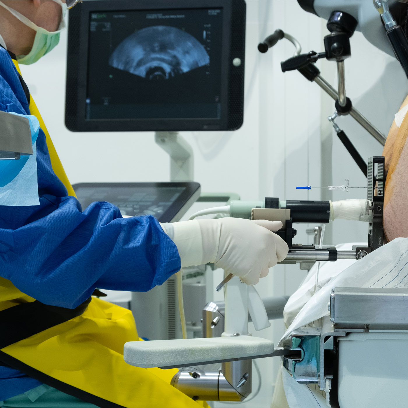 Einbringung einer Rektalen Ultraschallsonde bei der LDR-Brachytherapie zur Positionierung der Seeds. Die genaue Platzierung der Seeds erfolgt mit Hilfe von hochaufl&ouml;sendem Ultraschall, der die Prostata und die benachbarten Organe (Enddarm und Harnblase) dreidimensional darstellt.