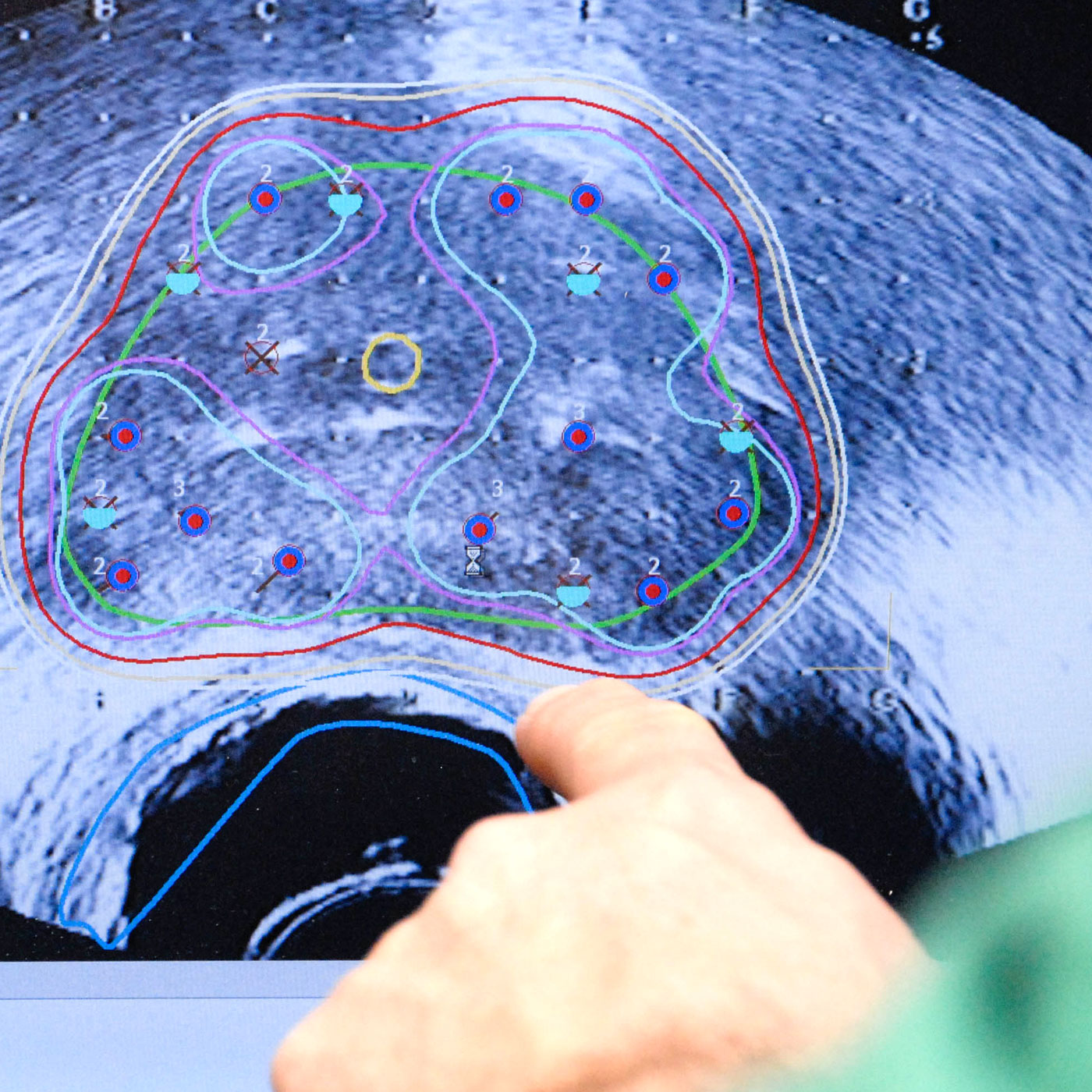 Bei der LDR-Brachytherapie wird unter Ber&uuml;cksichtigung verschiedener Toleranzdosen der Bestrahlungsplan sowie die Dosisverteilung des Zielvolumens und der Risikoorgane von der Medizinphysik mittels einer Planungssoftware berechnet.