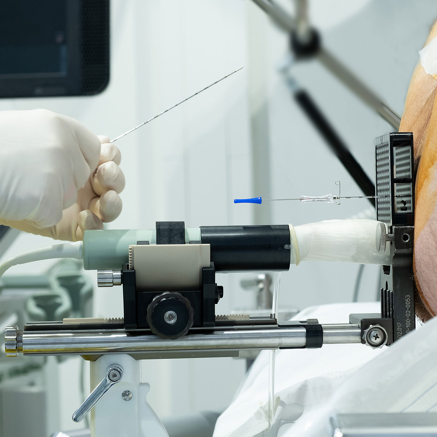 Implantation von Seeds in die Prostata bei der LDR-Brachytherapie durch uro-mobile GmbH